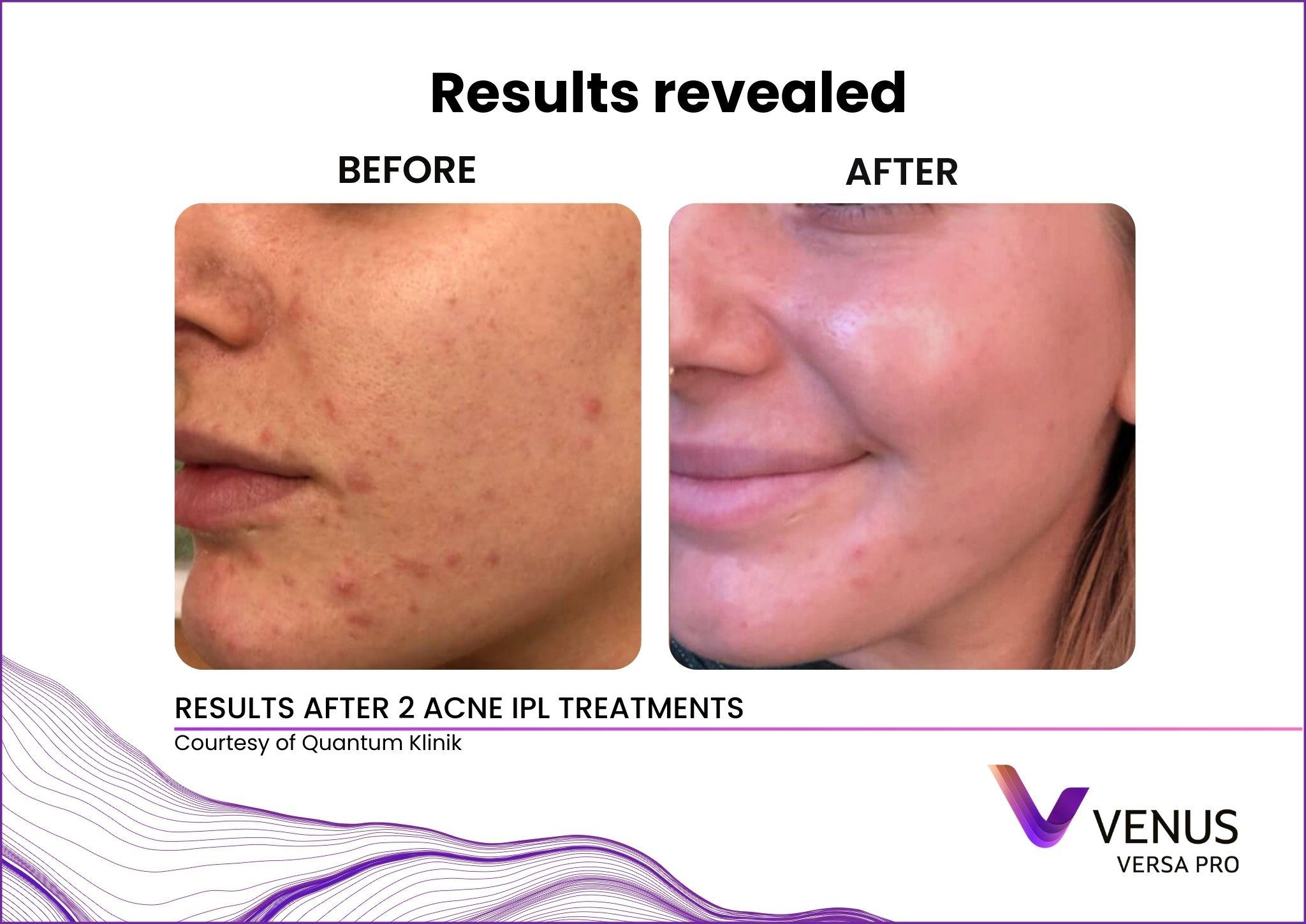 Acne IPL before and after results at Valley Aesthetic North Bergen NJ