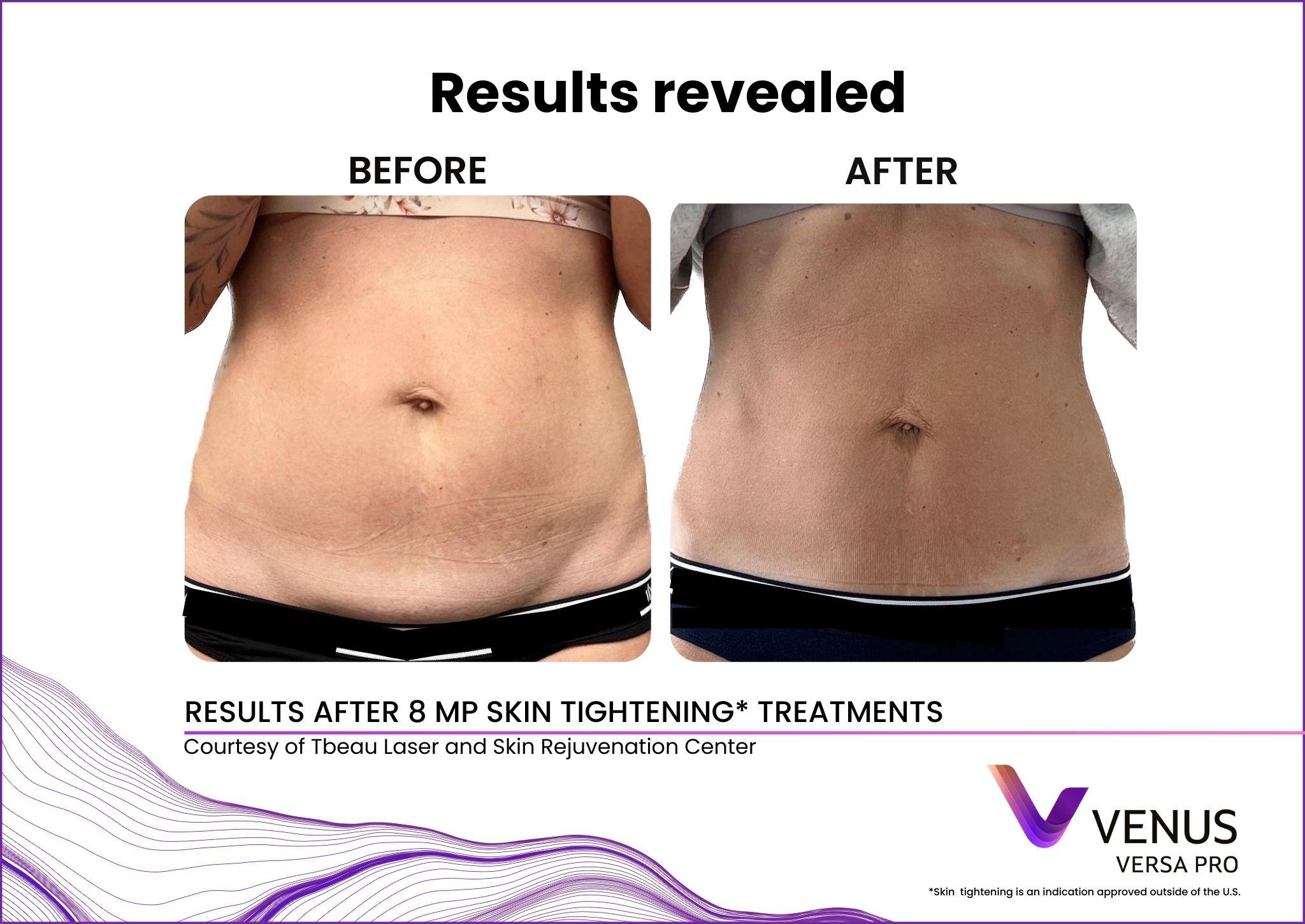 Body skin tightening before and after at Valley Aesthetic North Bergen NJ