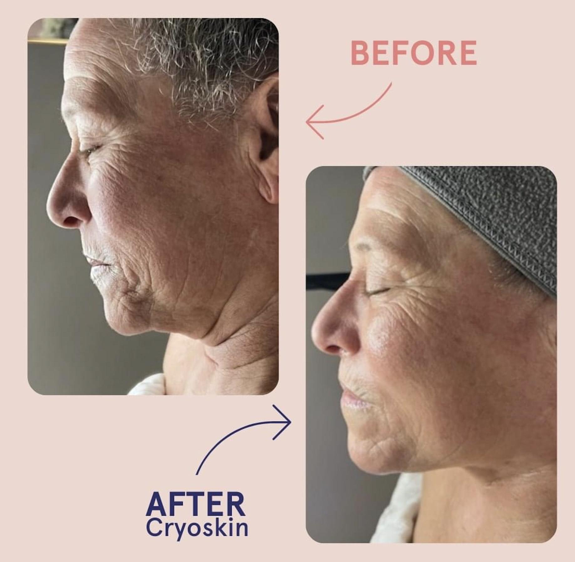 CryoFacial before and after results at Valley Aesthetic