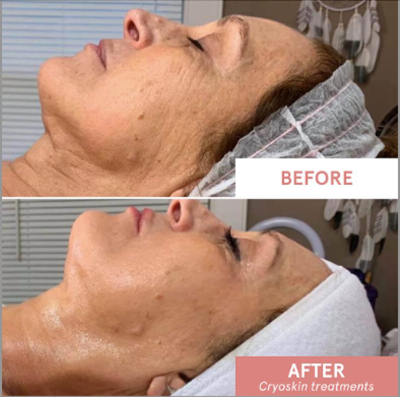 CryoFacial before and after results, second example, at Valley Aesthetic