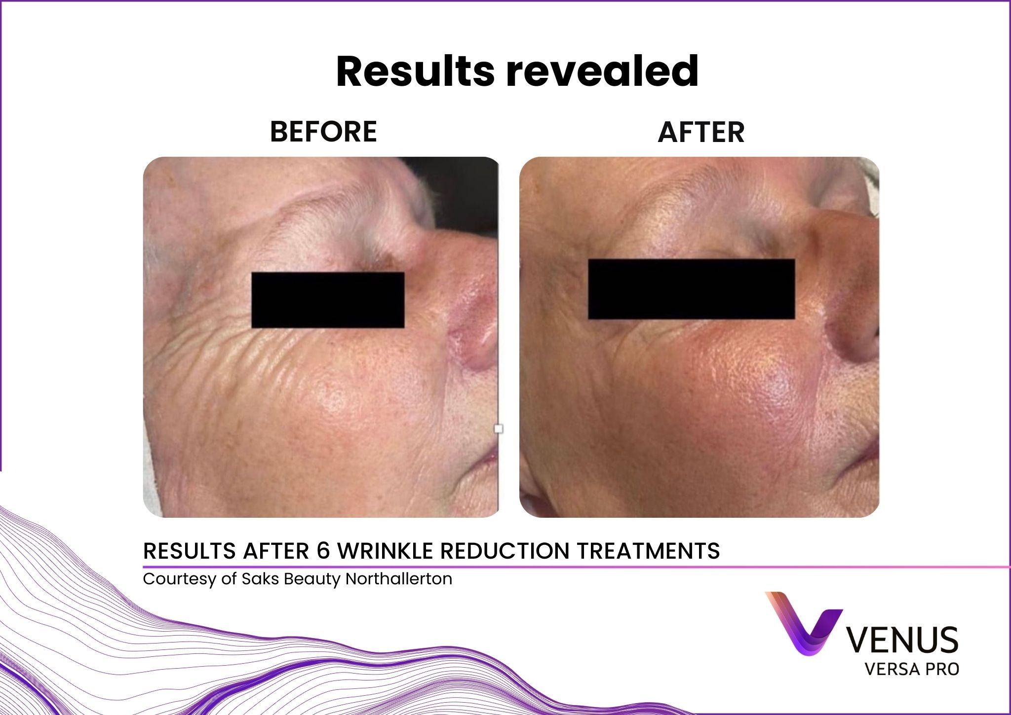 Diamond Polar facial tightening before and after at Valley Aesthetic