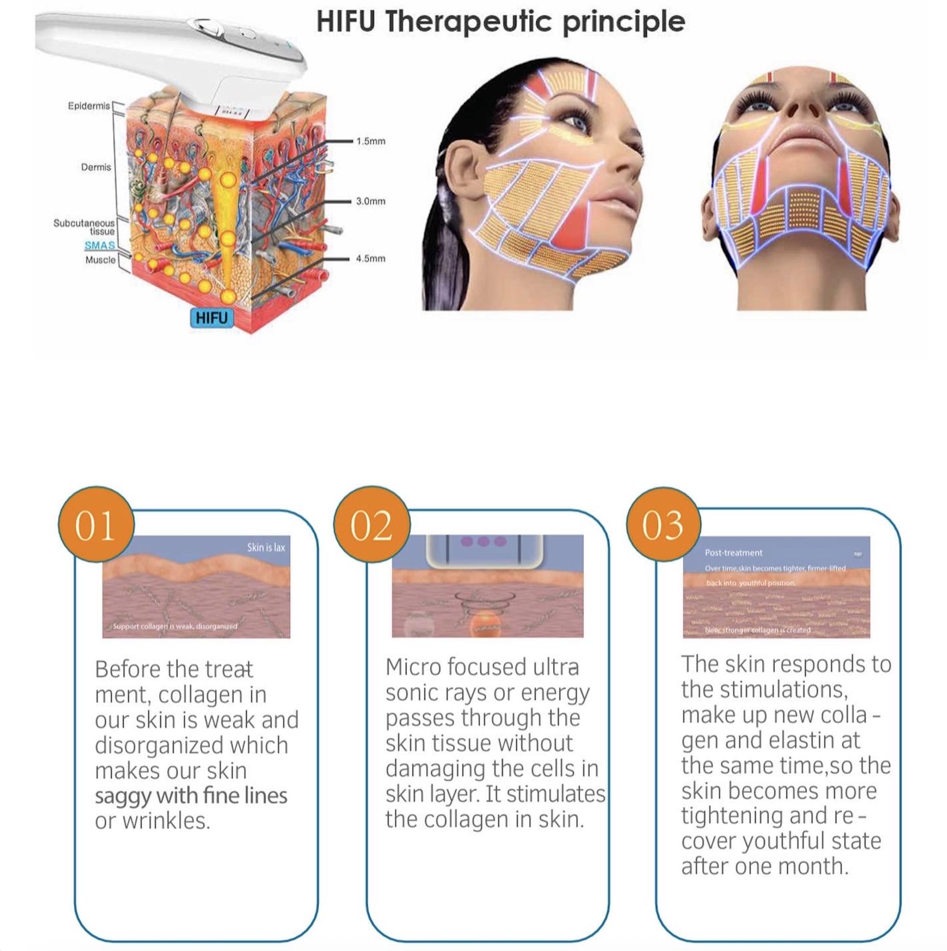 HIFU therapeutic principle diagram
