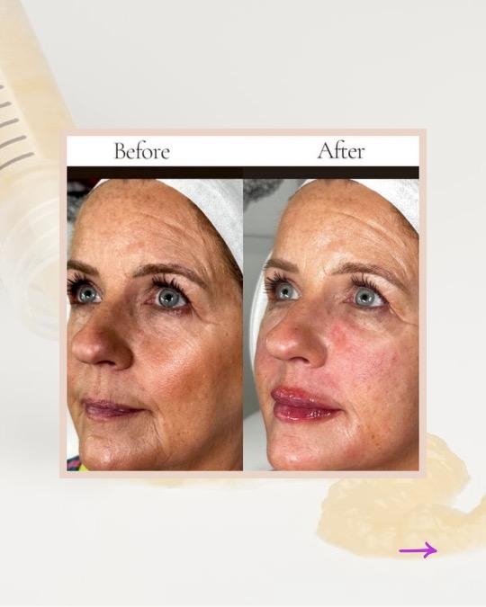 PRGF facial regeneration before and after at Valley Aesthetic