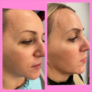 before&after-VI-peels-1