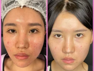 before&after-VI-peels-10