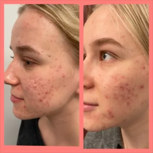 before&after-VI-peels-3