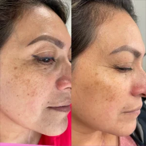 before&after-VI-peels-4