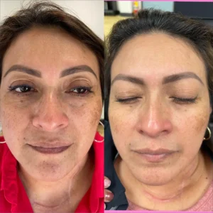 before&after-VI-peels-5