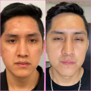 before&after-VI-peels-6