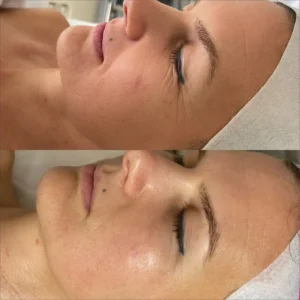 before&after-VI-peels-7