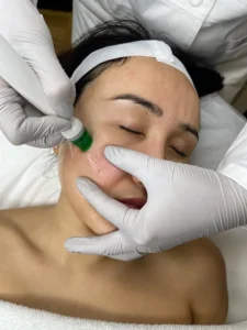 hidrofacial-gallery-2