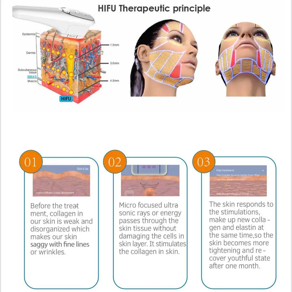 HIFU - High-Intensity Focused Ultrasound