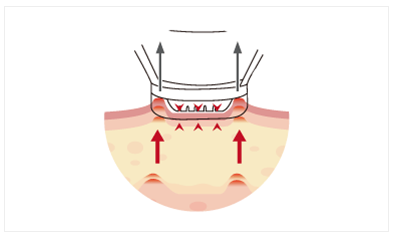 RF-Microneedling-2