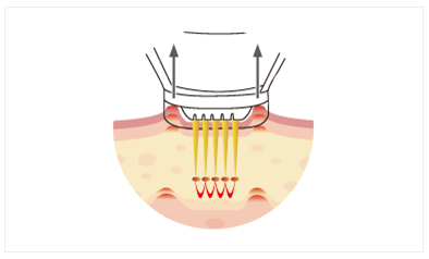 RF-Microneedling-3