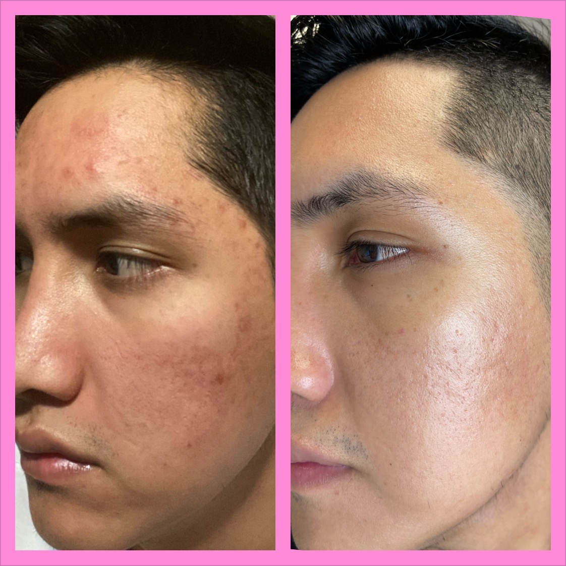 microneedling-13